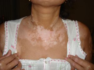 skin diseases Treatment