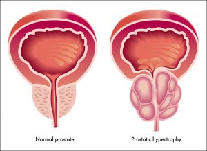 benign-prostatic-hyperplasia